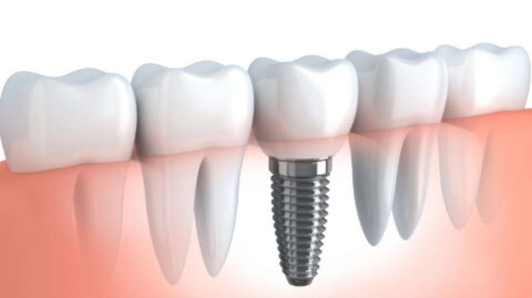 Advanced Dentistry of Coral Springs : Affordable Dental Implants in Coral Springs